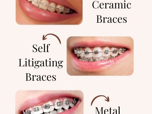 invisible-braces-in-powai