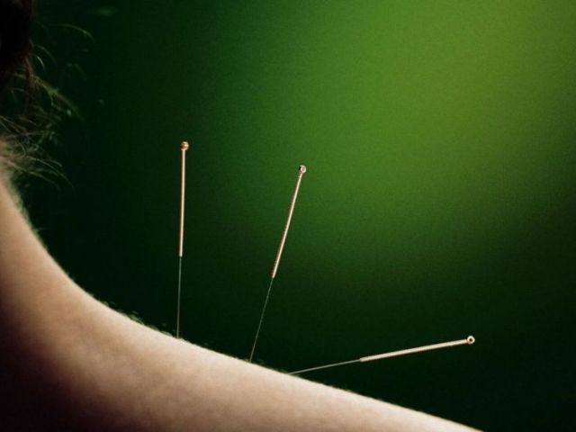 modern-wellness-through-electro-acupuncture-treatment