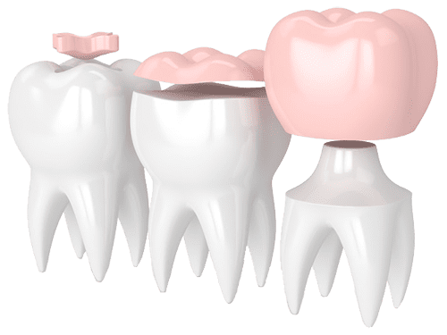 dental-crown-clinic-arizona-same-day-affordable-crown