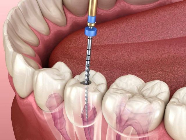signs-you-need-root-canal-treatment-in-north-brunswick