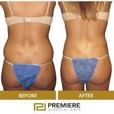 who-is-the-ideal-candidate-for-non-surgical-body-big-0