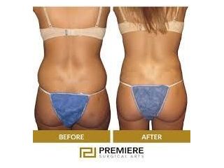 who-is-the-ideal-candidate-for-non-surgical-body-small-0