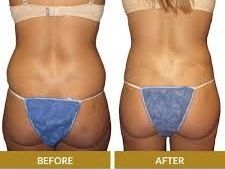 who-is-the-ideal-candidate-for-non-surgical-body