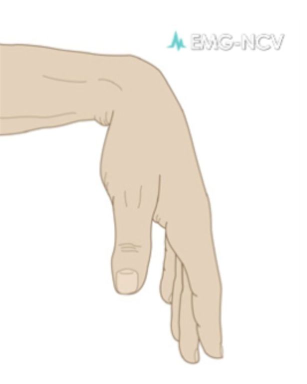 nerve-conduction-study-los-angeles-big-0