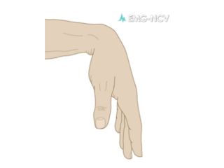 nerve-conduction-study-los-angeles-small-0