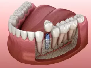 dental-implants-in-wilmington-smile-dental-implant-solutions-small-0