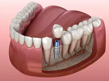 dental-implants-in-wilmington-smile-dental-implant-solutions