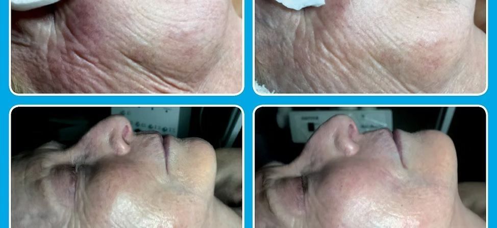 glo2facial-big-0