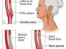 carotid-artery-stenosis-a-key-cause-of-stroke