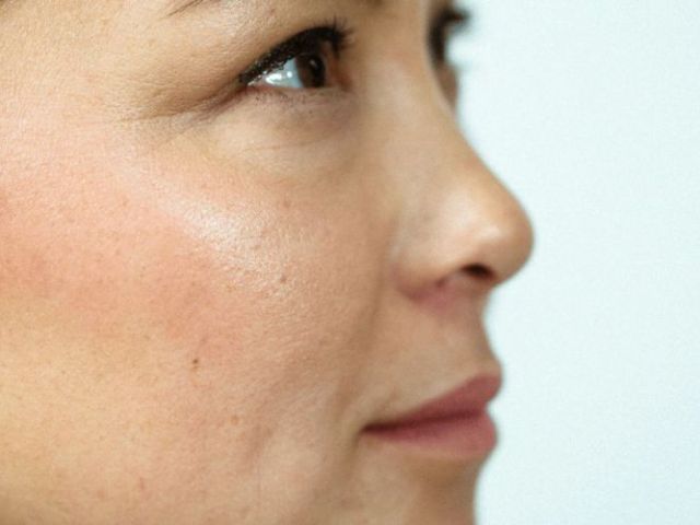 asian-glow-patch-a-simple-way-to-reduce-alcohol-flush