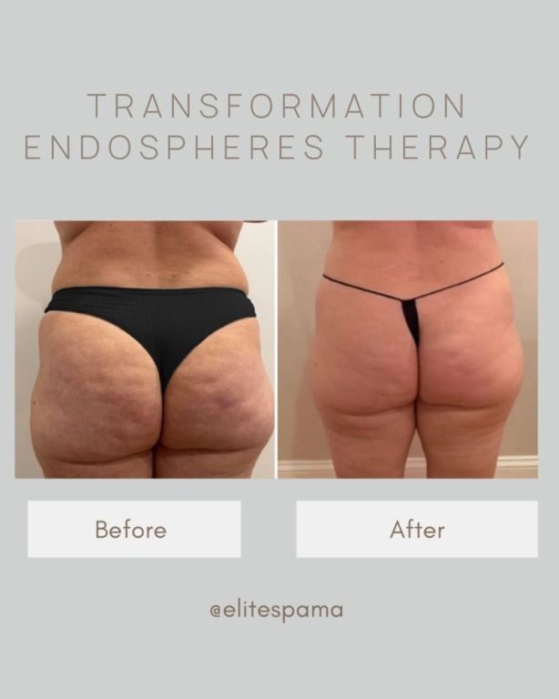 endospheres-boston-morpheus8-treatment-for-cellulite-reduction-big-0