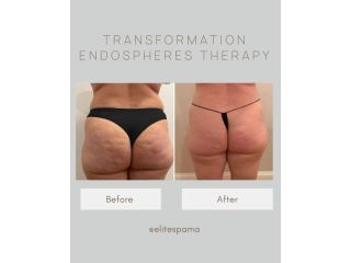 endospheres-boston-morpheus8-treatment-for-cellulite-reduction-small-0