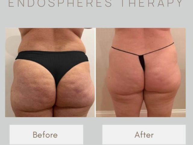 endospheres-boston-morpheus8-treatment-for-cellulite-reduction