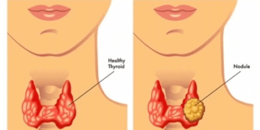 thyroid-nodule-treatment-for-safe-and-effective-care-big-0