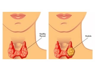 thyroid-nodule-treatment-for-safe-and-effective-care-small-0
