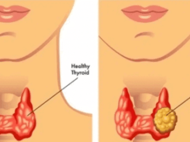 thyroid-nodule-treatment-for-safe-and-effective-care