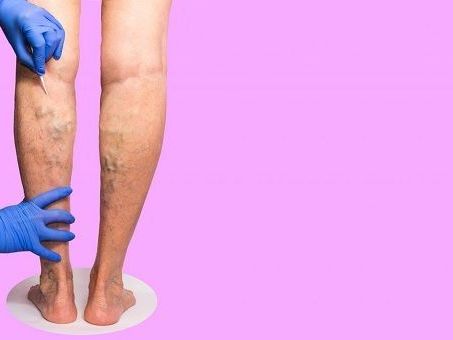 is-it-worth-getting-varicose-veins-remove