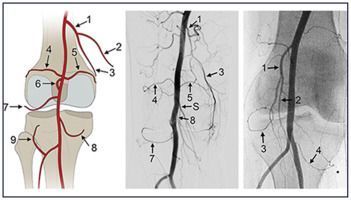 genicular-artery-embolization-cost-in-india-big-0