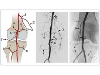 genicular-artery-embolization-cost-in-india-small-0