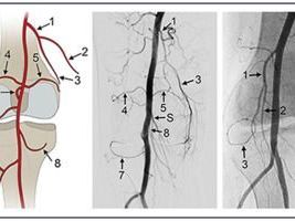 genicular-artery-embolization-cost-in-india