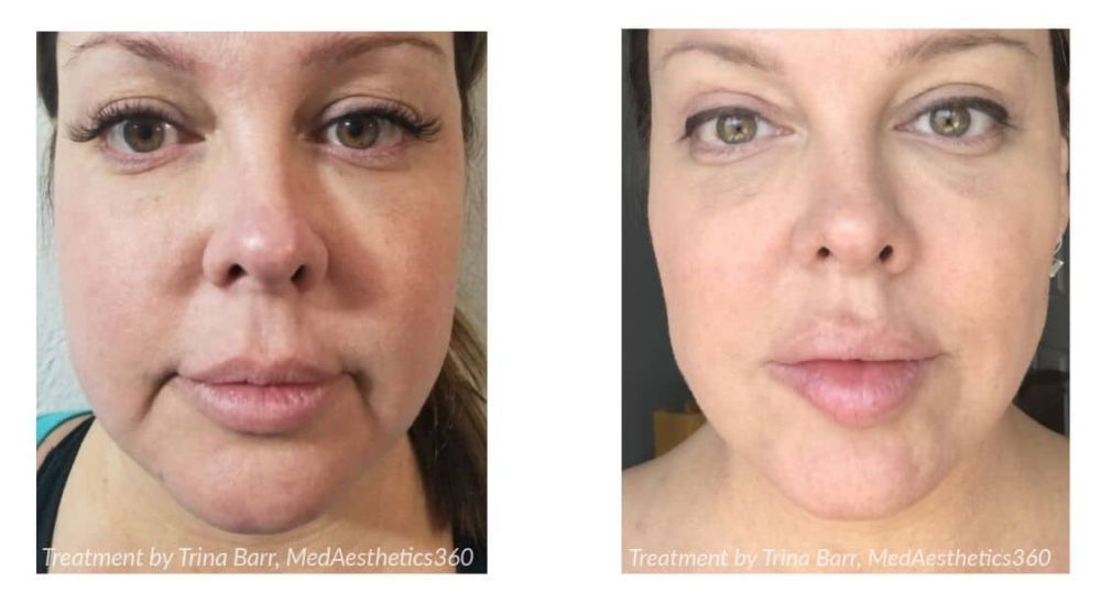 stretch-mark-removal-treatment-for-smooth-clear-skin-big-0