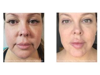 stretch-mark-removal-treatment-for-smooth-clear-skin-small-0