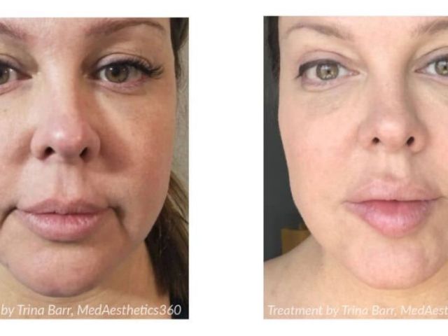 stretch-mark-removal-treatment-for-smooth-clear-skin
