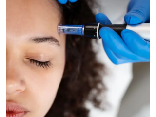 best-lip-filler-in-covina-ca-small-0