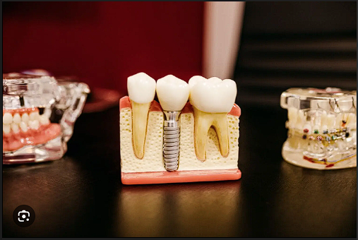 long-lasting-dental-implants-in-chandler-for-missing-teeth-big-0