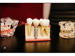 long-lasting-dental-implants-in-chandler-for-missing-teeth-small-0