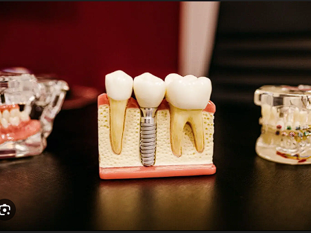 long-lasting-dental-implants-in-chandler-for-missing-teeth