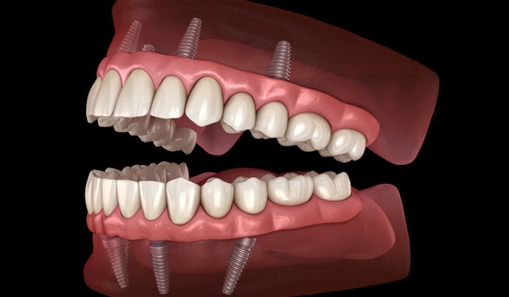 transform-your-smile-with-all-on-x-implant-dentures-in-houston-big-0
