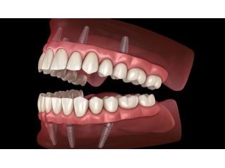 transform-your-smile-with-all-on-x-implant-dentures-in-houston-small-0