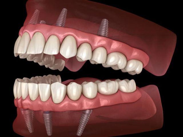 transform-your-smile-with-all-on-x-implant-dentures-in-houston