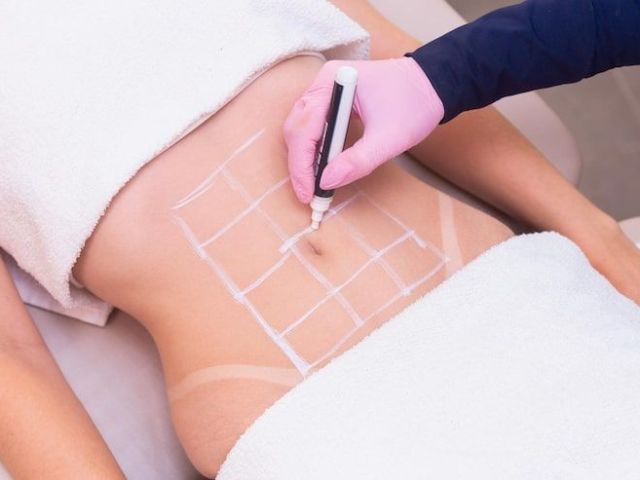 book-now-affordable-body-sculpting-treatments-in-hollister