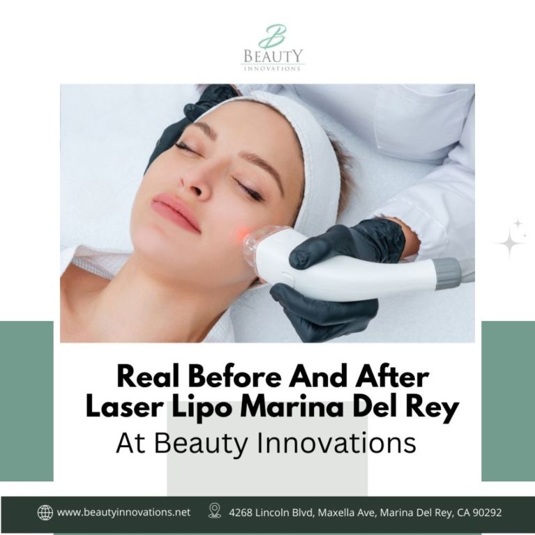 real-before-and-after-laser-lipo-marina-del-rey-at-big-0