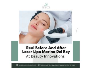 real-before-and-after-laser-lipo-marina-del-rey-at-small-0