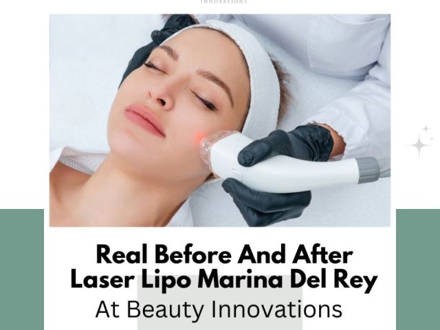 real-before-and-after-laser-lipo-marina-del-rey-at