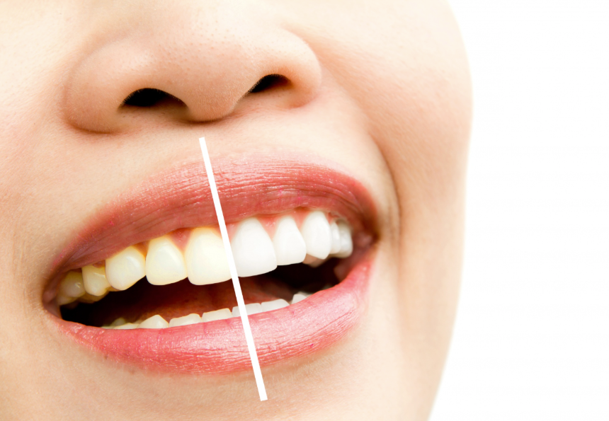 expert-orthodontist-lake-oswego-for-perfect-smiles-big-0