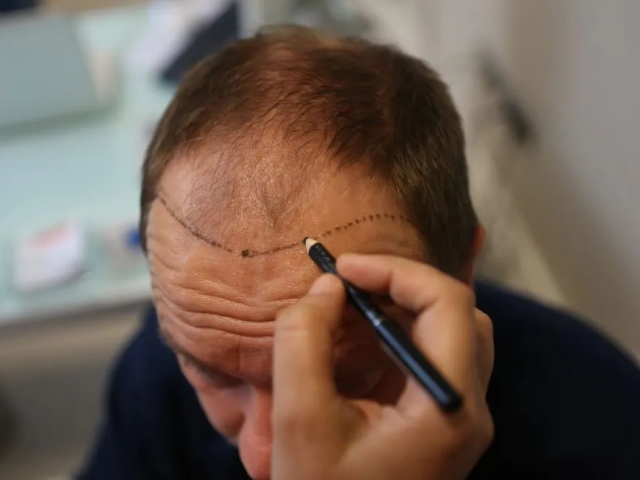 buk-clinic-turkey-hair-transplant-aesthetic-treatments