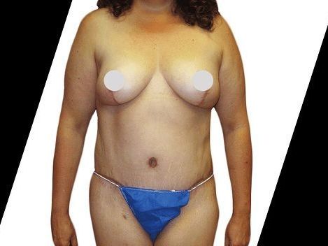 what-are-the-most-popular-procedures-combined-in-a-houston
