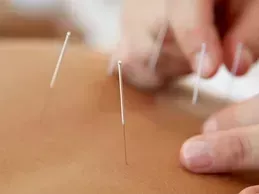 dry-needling-treatment-in-jefferson-city-tennessee