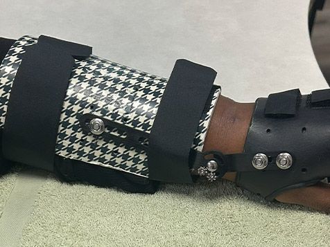 custom-bracing-and-splint-for-wrist-in-bronx-new-york