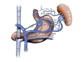 understanding-portal-hypertension-radiology-procedures-small-0