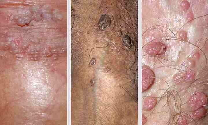 struggling-with-genital-warts-get-discreet-permanent-treatment-big-0