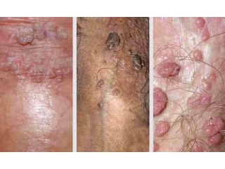 struggling-with-genital-warts-get-discreet-permanent-treatment-small-0