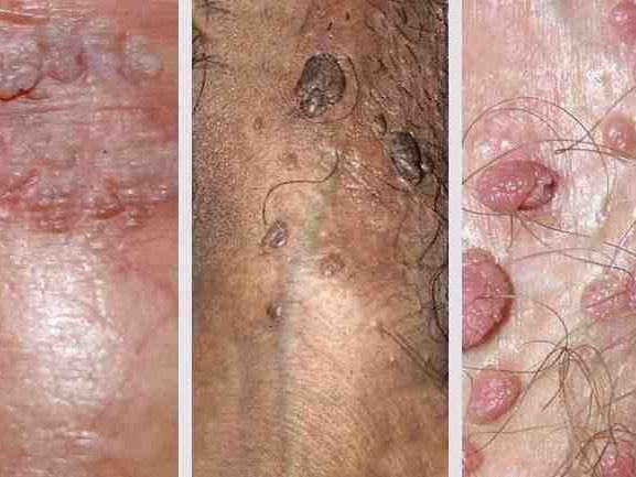 struggling-with-genital-warts-get-discreet-permanent-treatment