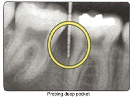 homecare-for-periodontal-disease-pinefield-dental-big-0