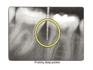 homecare-for-periodontal-disease-pinefield-dental-small-0