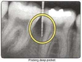 homecare-for-periodontal-disease-pinefield-dental